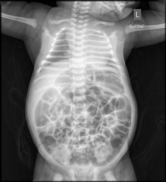 Ảnh chụp X-quang ổ bụng đầy hơi của bé Mai