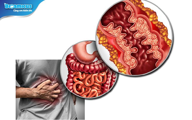 viêm ruột gây tiêu chảy ở trẻ