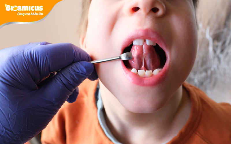 dây thắng lưỡi ngắn gặp ở 5% số trẻ khỏe mạnh