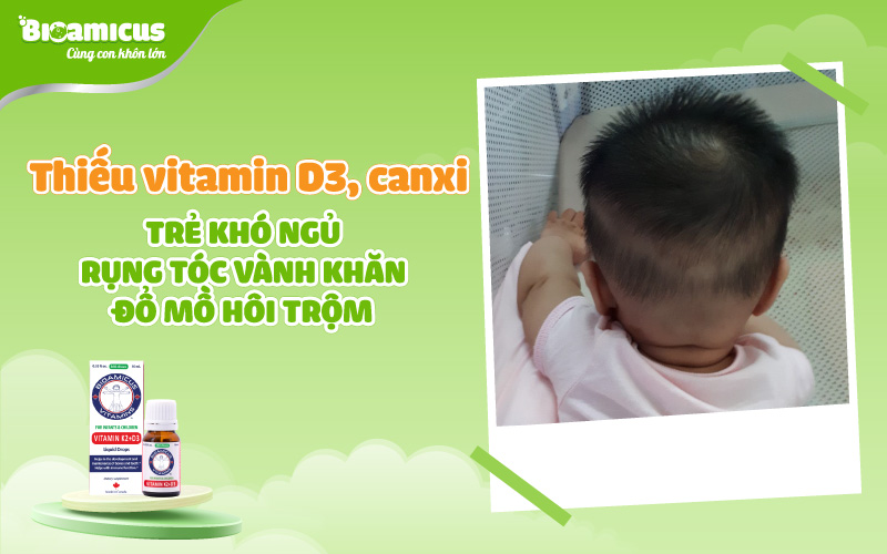 thiếu vitamin d3 canxi khiến trẻ ra mồ hôi, rụng tóc vành khăn