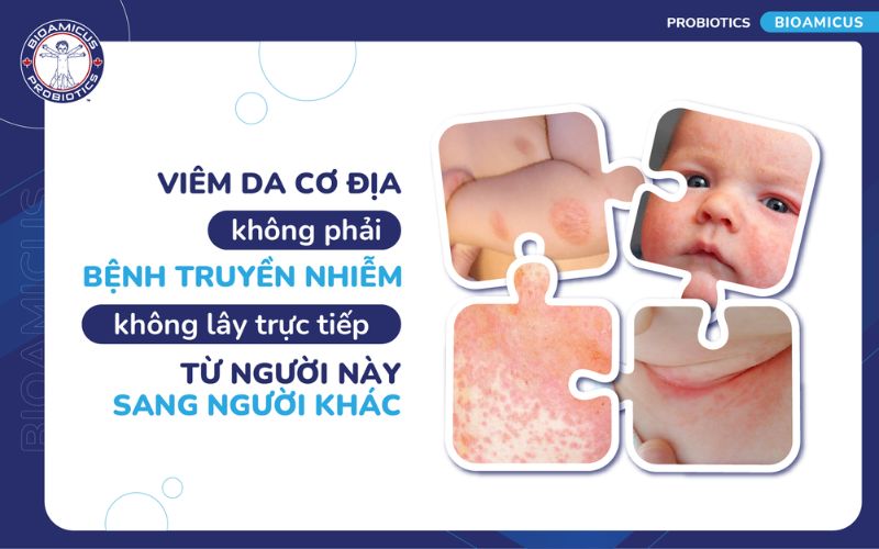 Viêm da cơ địa không phải bệnh truyền nhiễm