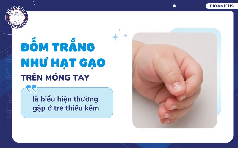 M&oacute;ng tay trẻ thiếu kẽm thường c&oacute; đốm trắng