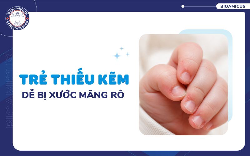 Trẻ thiếu kẽm xước măng r&ocirc;