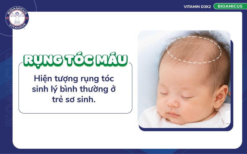 Rụng t&oacute;c m&aacute;u