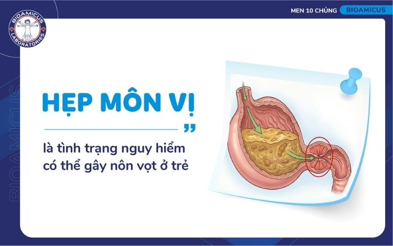 Hẹp môn vị gây nôn vọt