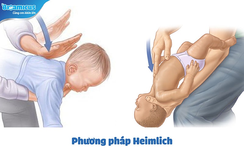 trẻ sơ sinh trớ ra sữa màu vàng dùng phương pháp Heimlich