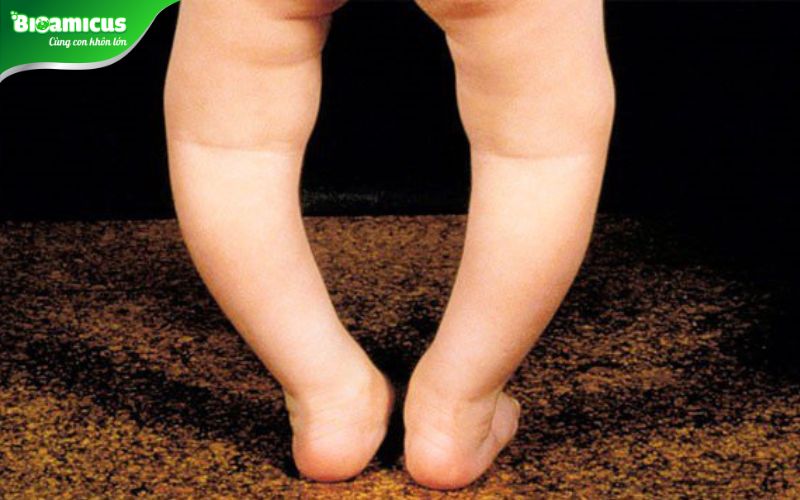 trẻ chân vòng kiềng là dấu hiệu trẻ bị bệnh lùn
