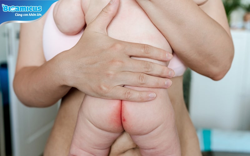dấu hiệu trẻ sơ sinh bị viêm hậu môn
